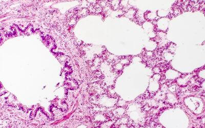 Neutrophilic inflammation during lung development disrupts elastin assembly and predisposes adult mice to COPD (2021)